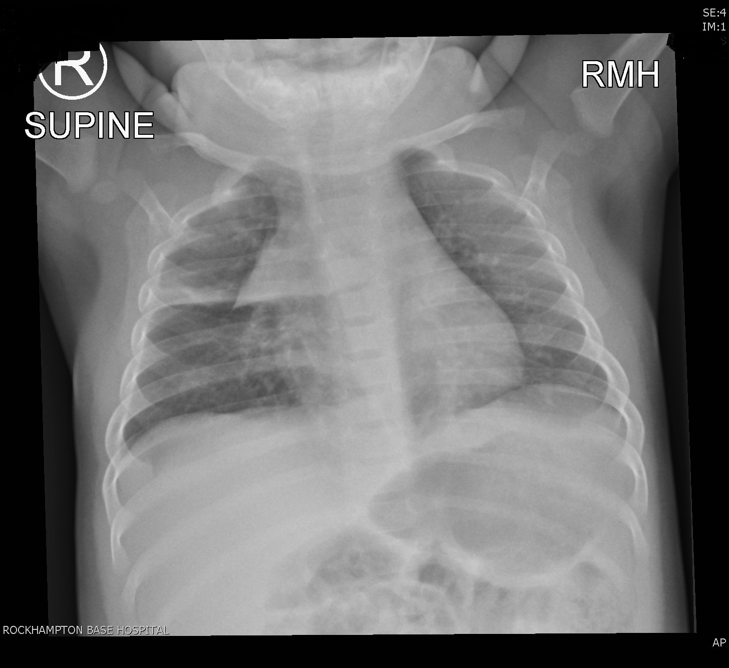                    Right upper lobe Pneumonia                                                                                                                                                                                                                                                                    