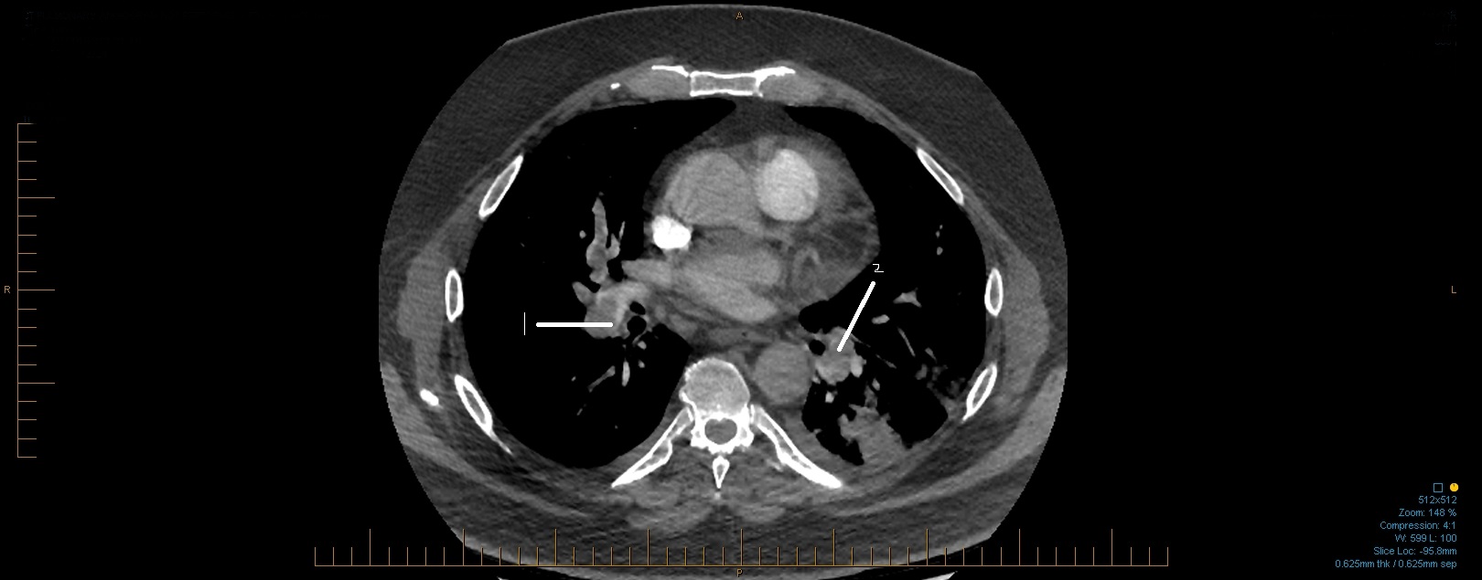 Pulmonary Embolism