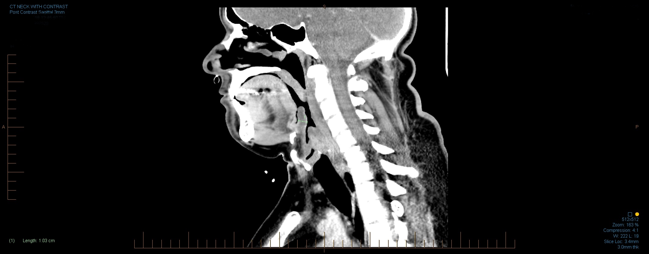  Epiglottitis 