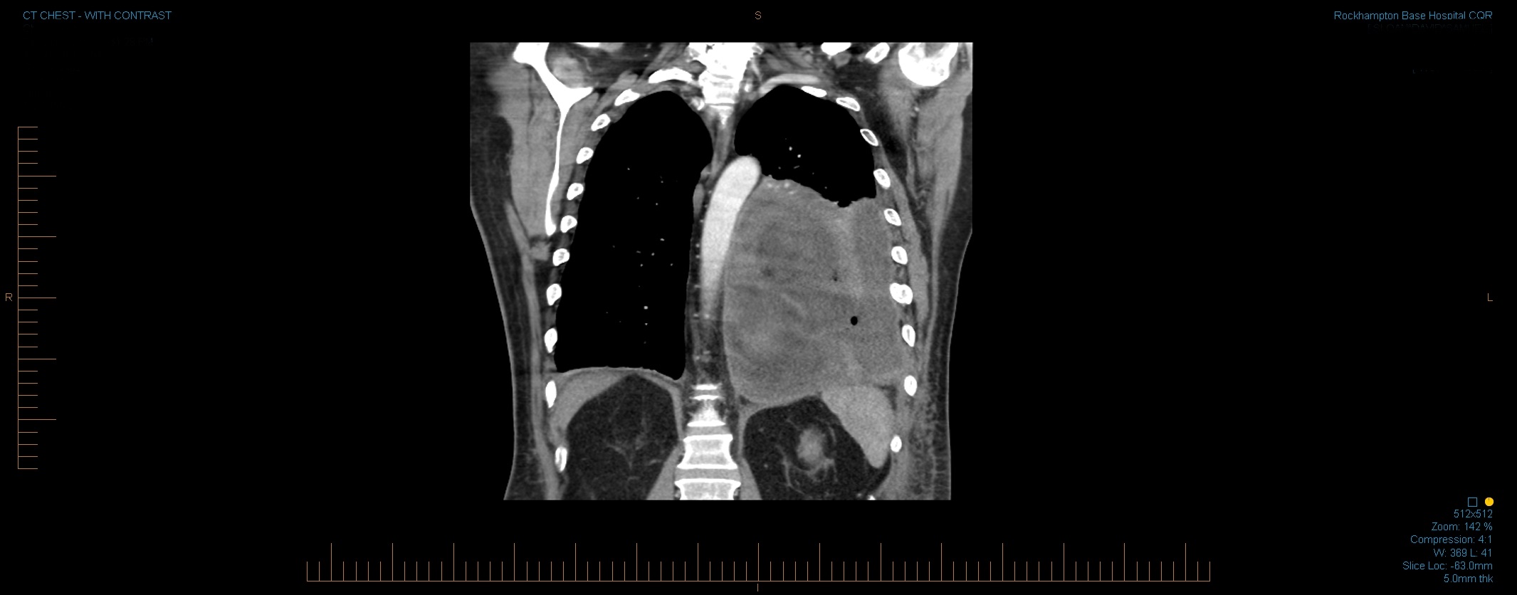 Lung Abscess